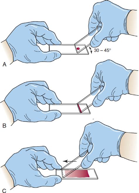 thick and thin smear test|a properly prepared wedge smear.